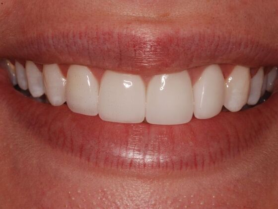 After Cosmetic Dental Treatment